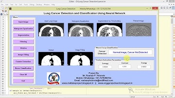 Lung Cancer Detection Using Neural Network Matlab Project with Source Code