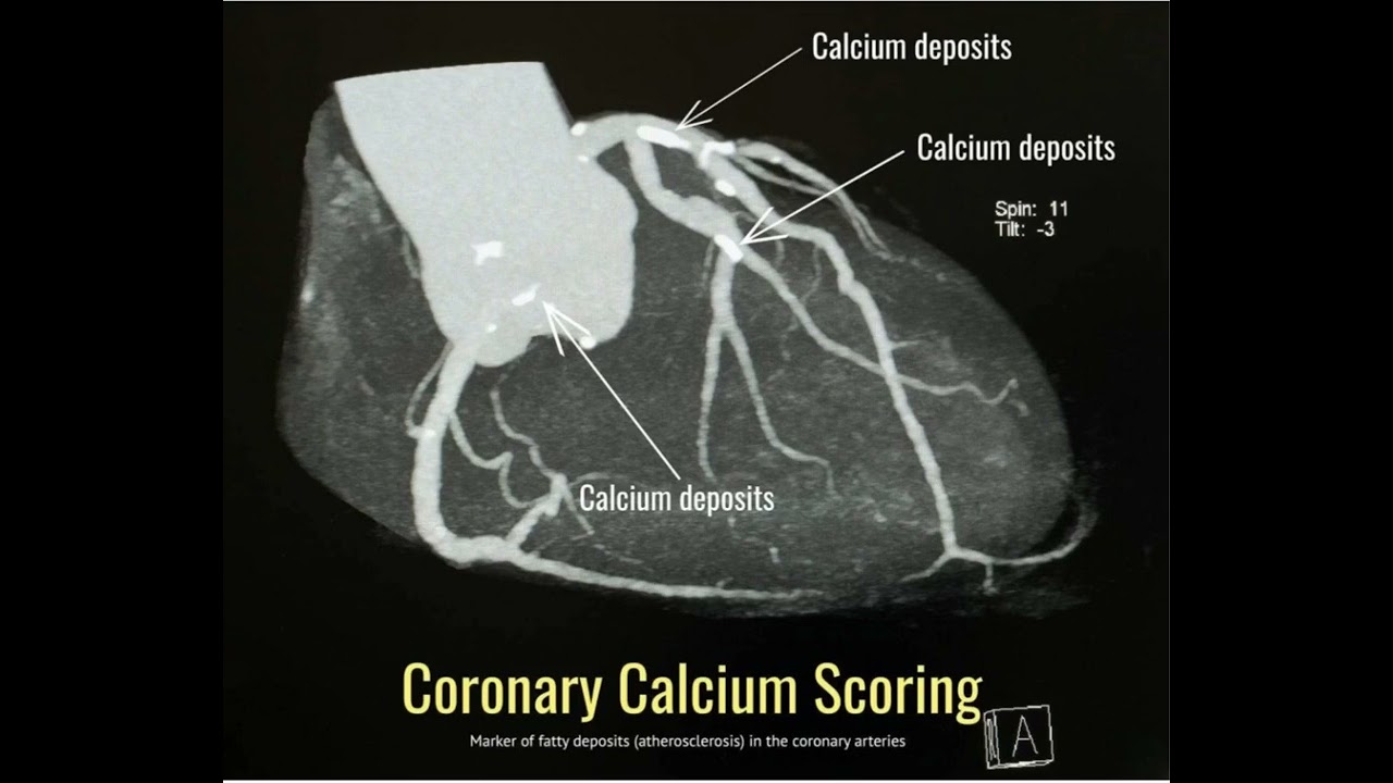 Over 50 years old! you must take the Coronary Artery Calcium test!!