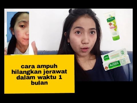 cara-ampuh-hilangkan-jerawat-dalam-waktu-1-bulan|-acnes-series