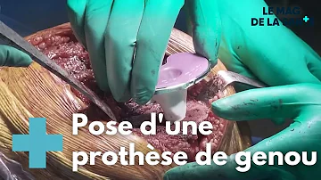 Pourquoi faire une arthroplastie