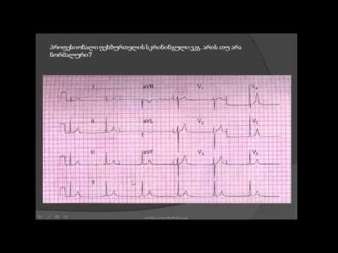 აჩქარებული იდიონოდური რითმი (achqarebuli idionoduri ritmi). მოკლე PQ ინტერვალი. AV დისოციაცია