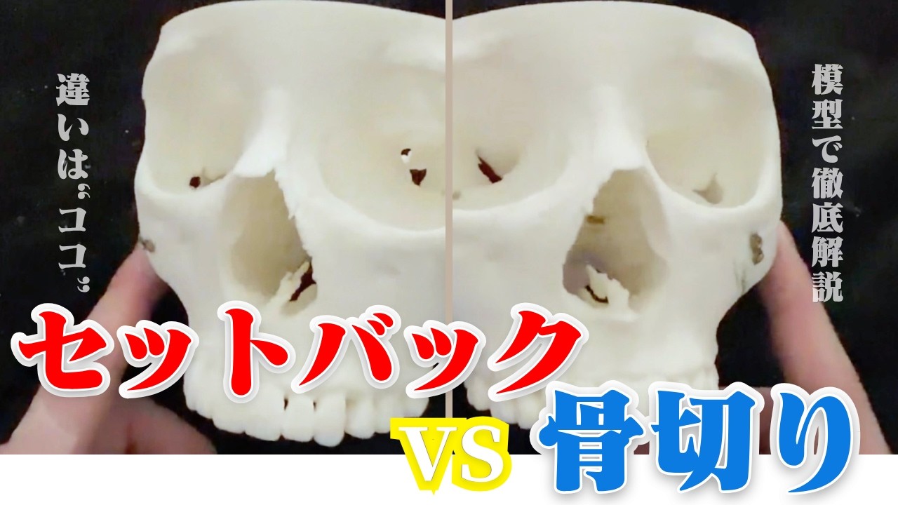 Zygomatic bone reduction] Differences from setback explained with