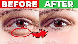 How to Get Rid of Under EYE BAGS For Good! by Incredibly Healthy 1,129 views 1 month ago 11 minutes, 44 seconds