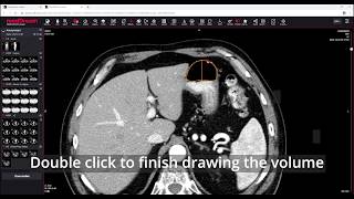 MedDream DICOM Viewer: measure the volume