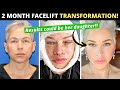49 Year Old Turns Back the Clock 10 Years with Facelift and Lip Lift! Two Month Facelift Journey