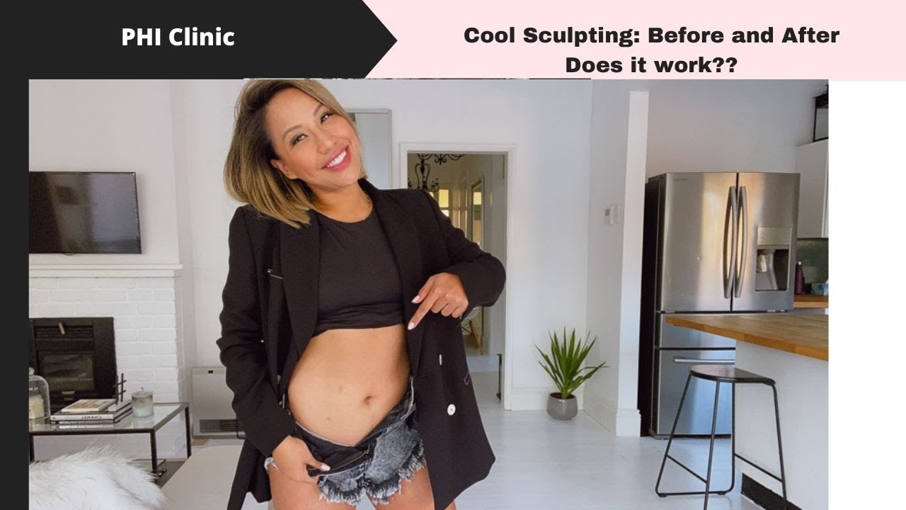 CoolSculpting: Does it work and is it safe?