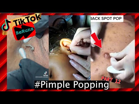 Over 15 Minutes Of Pimple Popping/ Black Heads Extractions- TikTok Compilation | Part 12