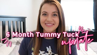 6 Month Tummy Tuck Surgery Update