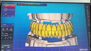 Full Arch Digital Design in Exocad | DEYU Dental Lab
