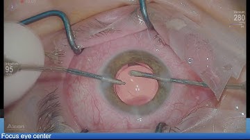 Fuchs dystrophy, Alcon IQ , low fluidics Lukan Mishev Live Stream