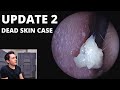 UPDATE 2 On Rapid Skin Shedding Case