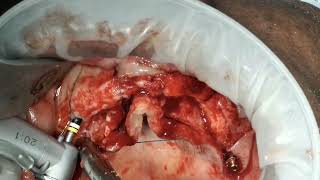 3BTB 6 concept to treat edentulous maxilla [cortical bone] using jd  implants -Dr. C. Murugavel