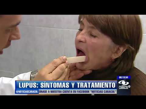 Video: Cómo prevenir la caída del cabello por lupus: 11 pasos (con imágenes)