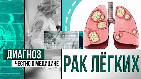 Уходят с дымом: почему рак лёгких убивает тысячи казахстанцев | Диагноз