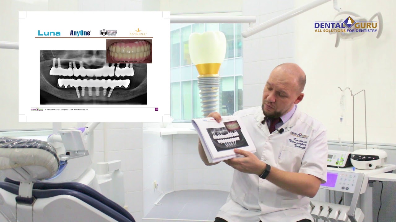 Что такое имплантация всё на 6-и (All-on-6)? Доступно о сложном.