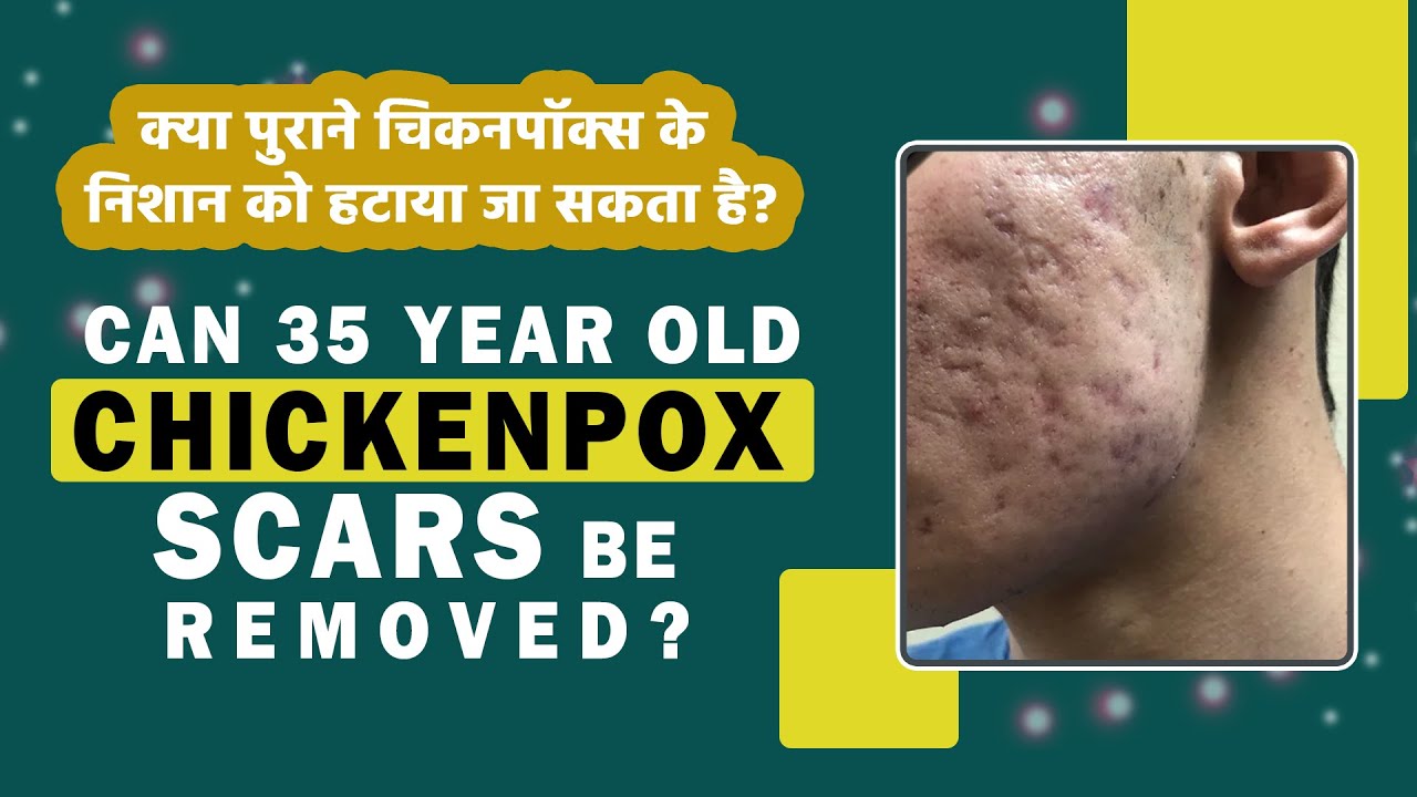 Can 35YearOld Chicken Pox Scars be Removed? Cosmetic Surgery for Scar
