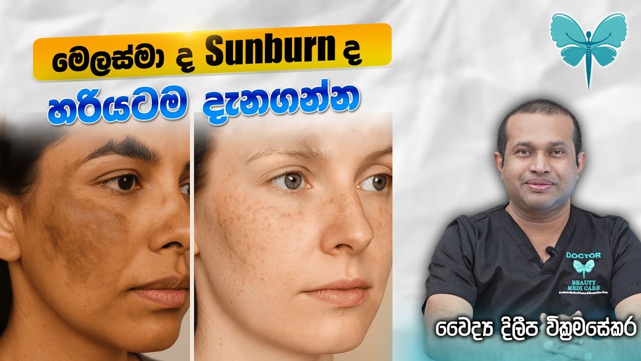 Do You Know About Melasma?