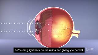 Benefits of Ortho-K