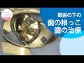神経を取った歯に違和感…歯の根の先に膿が?!根管治療 Root Canal Treatment Using A Microscope!!