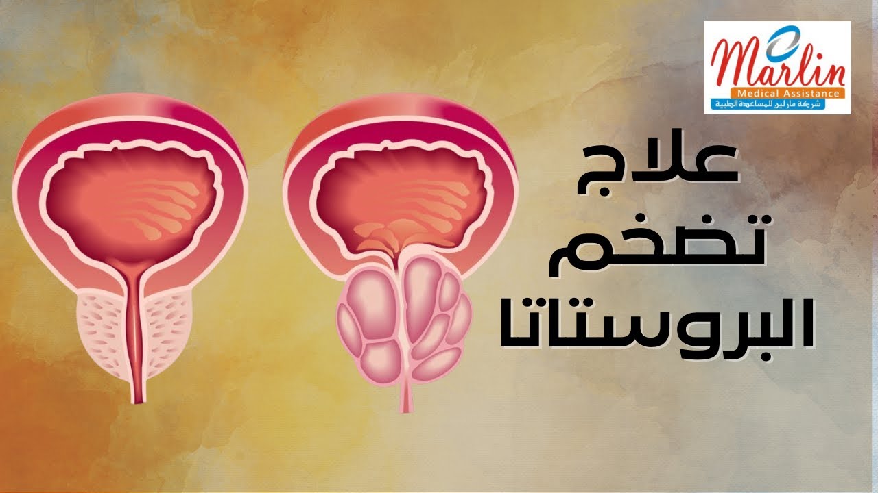 مشاكل البروستات || حرقان البول والجماع || إعراضه وعلاجه