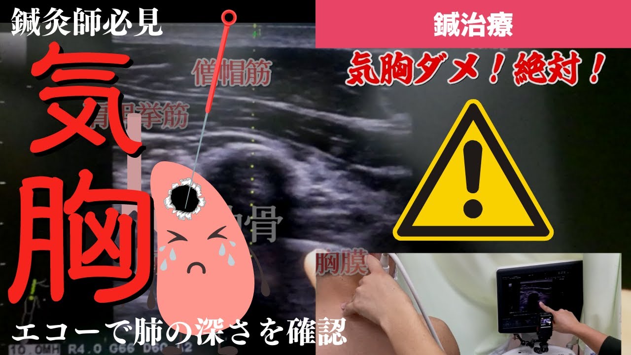 [Никакого пневмоторакса! Ни в коем случае!!!] Чтобы обеспечить должную информированность и безопа...