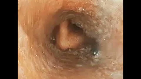 Walking through tracheal SEMS (stent) : Dr. Jaykum...