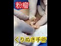 粉瘤のくりぬき手術動画【surgery of atheroma,epidermal cyst】　#粉瘤　#atheroma #epidermal cyst #くりぬき
