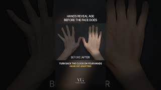 Why Your Hands Look Older Than Your Face (Hand Fat Transfer Before &amp; After) #plasticsurgery