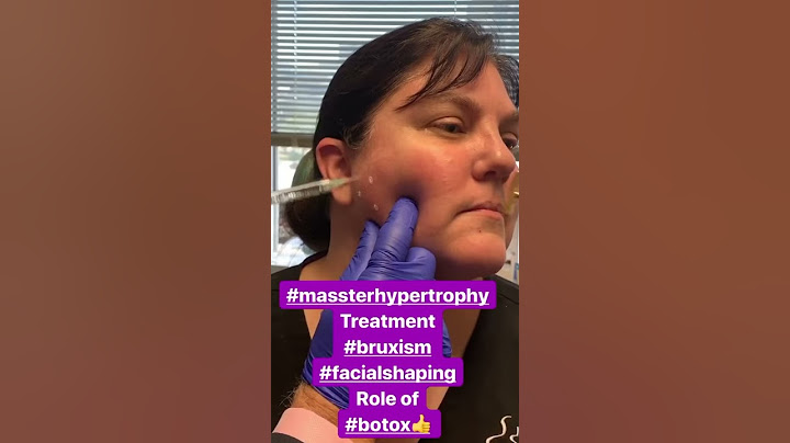 Botox for treatment of tooth grinding