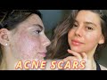 MY SECRETS TO HEAL ACNE SCARS FAST: Struggling With Pigmentation