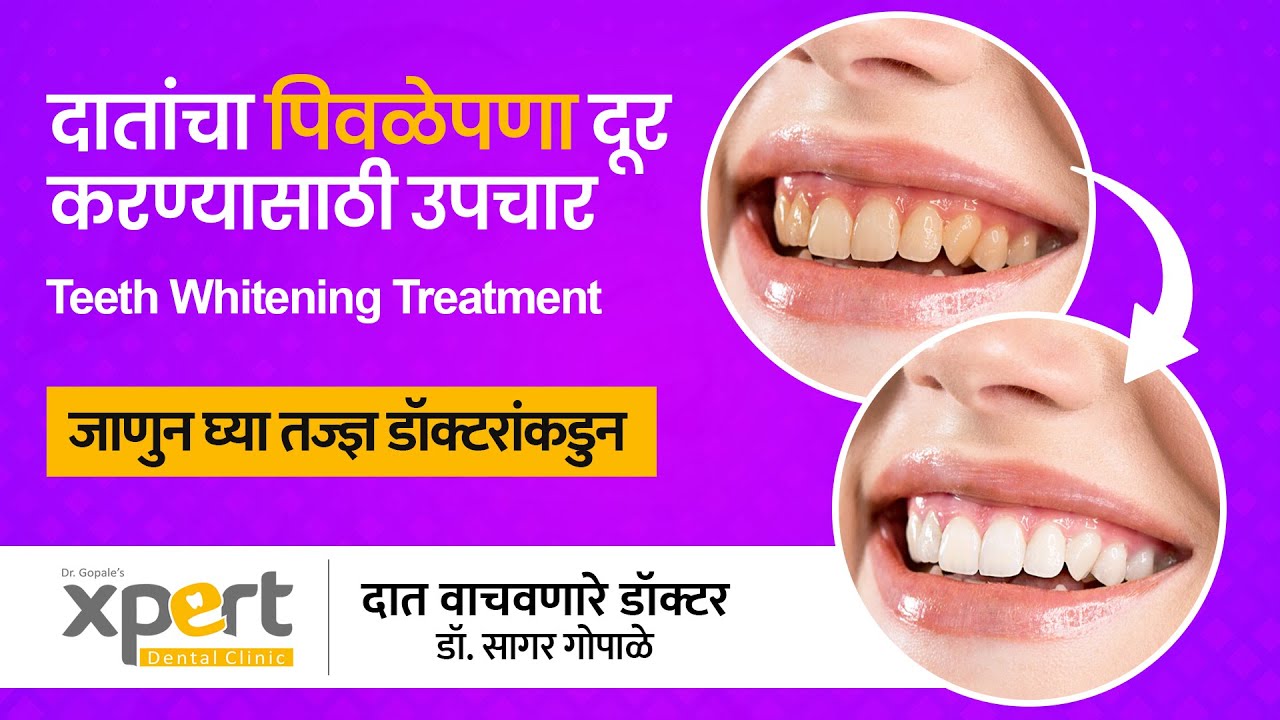 दातांचा पिवळेपणा दूर करण्यासाठी उपचार Teeth Whitening treatment