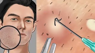 {ASMR} shaving sound+ ingrown hair removal Animation ||
