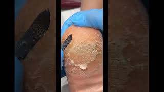 Heel Callus Removal