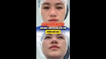 Mũi từng can thiệp cấy chỉ và ti.êm Filler nhưng không hiểu quả??? | Dr.KOKO