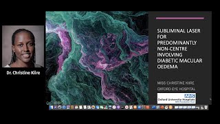 EURETINA 2020 - SubLiminal Laser for predominantly non-center involving DME?