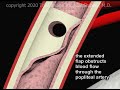 Popliteal Artery Intimal Tear due to Surgical Stress Animation by Cal Shipley, M.D.