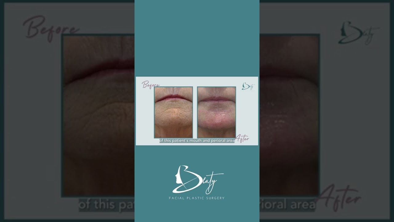 Dr. Mark Beaty discusses CO2 laser resurfacing to get rid of wrinkles with before and after photos.