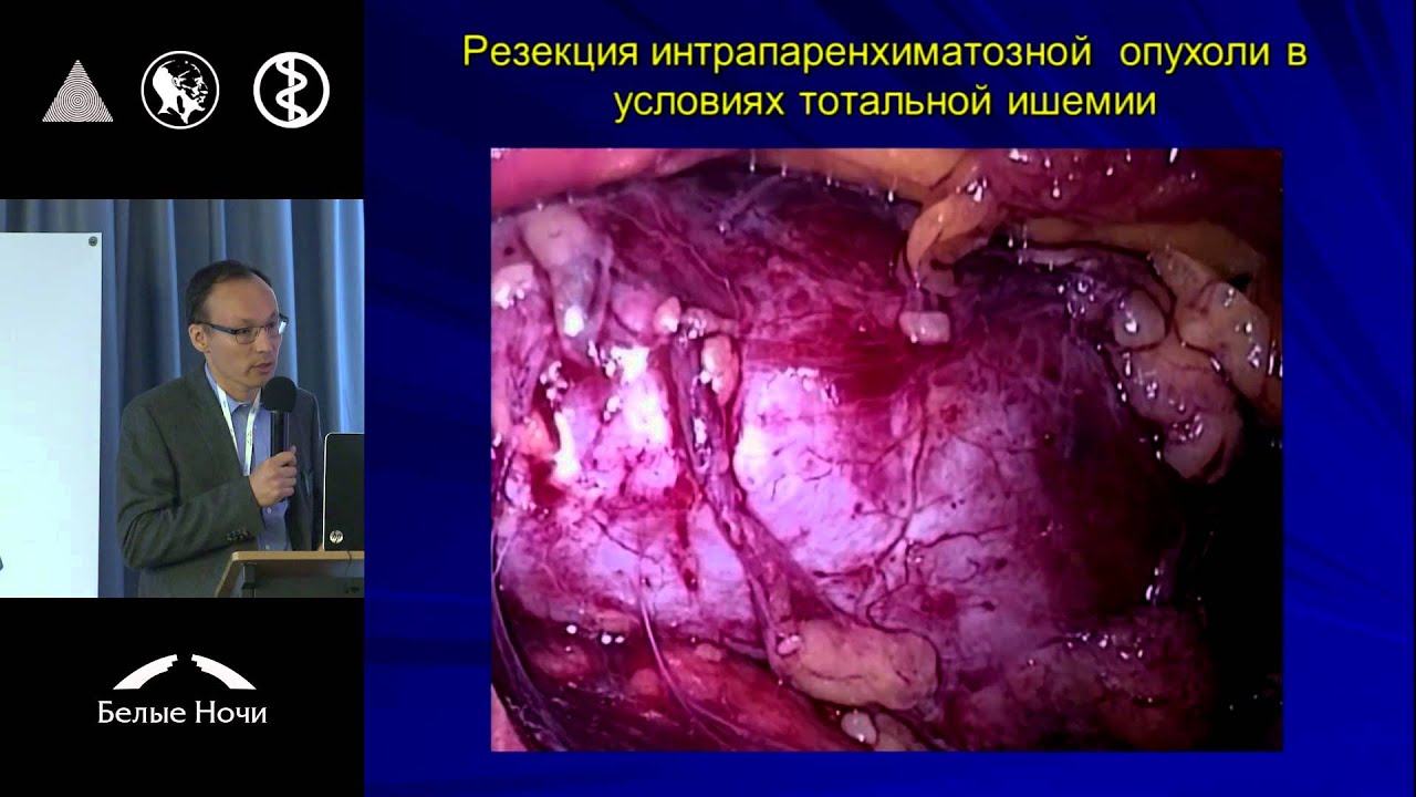 Существуют ли ограничения для лапароскопической резекции опухолей почек