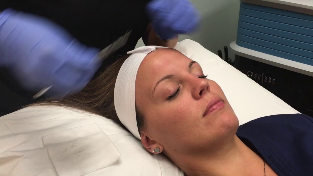Dermaplaning and Chemical Peel Demonstration & Results YouTube
