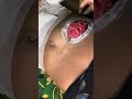 Stoma Bag Description Bangla || Surgery Short Case #medical #surgeryday #injury #belly #abdomen