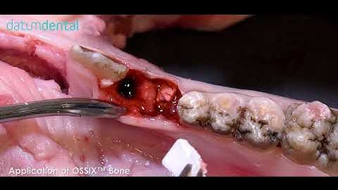 MKT 0001300   Socket preservation using OSSIX Bone