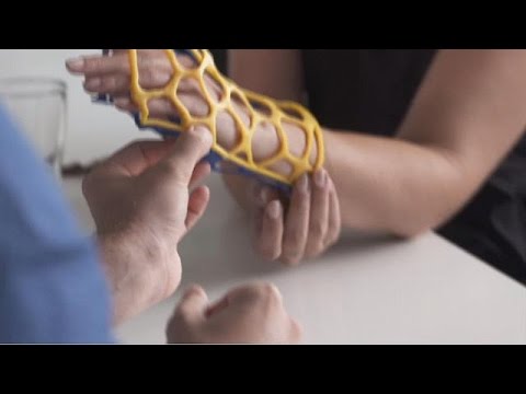 Un plâtre futuriste en 3D pour soigner les fractures plus rapidement -  YouTube