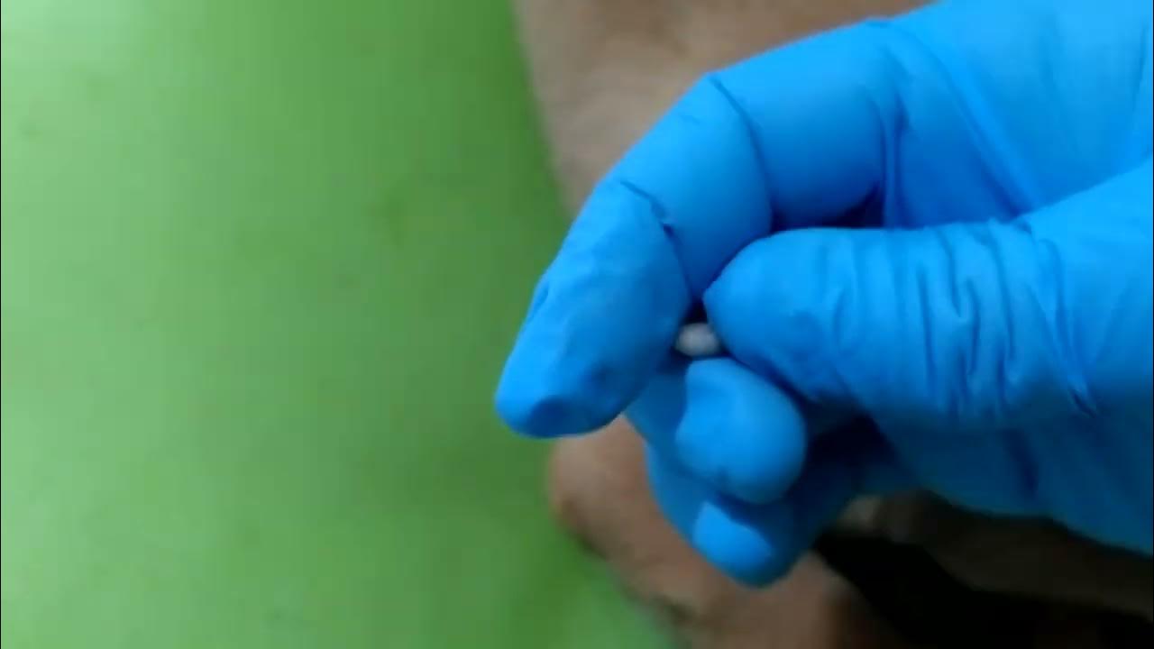 Comment Faire Sortir Un Ver De Cayor vers de cayor. cordylobia - YouTube