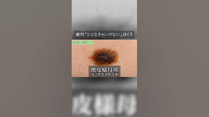 絶対取らなきゃいけないほくろ #Shorts