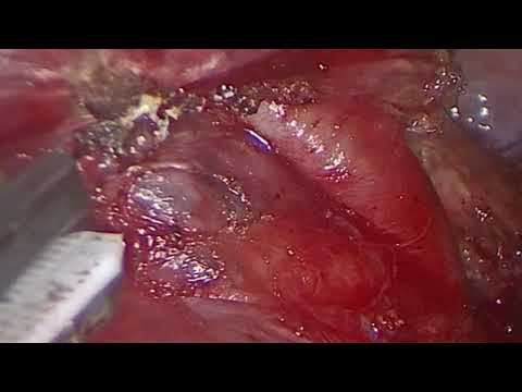 Uniportal VATS RUL apical RS1 segmentectomy