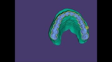 exocad Tutorial: Digital Prep Model