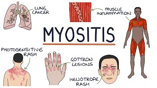 Understanding Myositis (Polymyositis and Dermatomyositis)