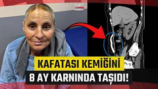 Hayat Kurtaran Sıradışı Operasyon! Kafatası Kemiğini 8 Ay Karnında Taşıdı - TGRT Haber