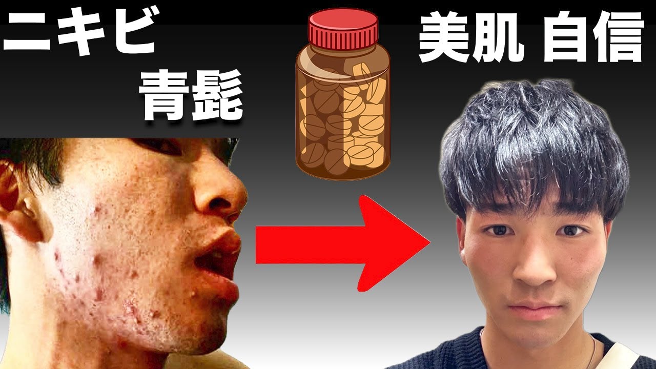 【閲覧注意】過去ニキビマンだった僕が肌を劇的に綺麗にした方法
