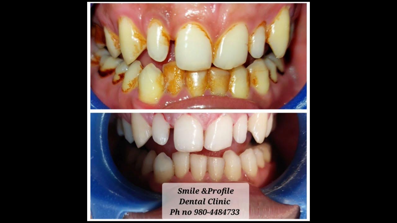 say-no-to-gutka-clean-mouth-healthy-mouth-dentist-teeth